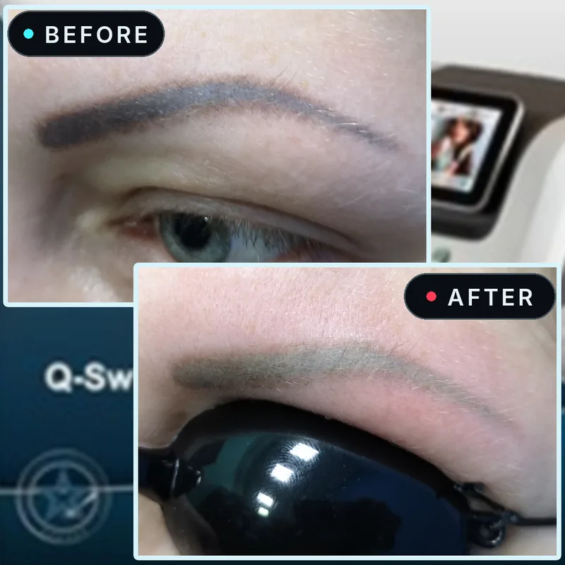 Eyebrow tattoo before laser treatment, dark grey, and after, much lighter and faded