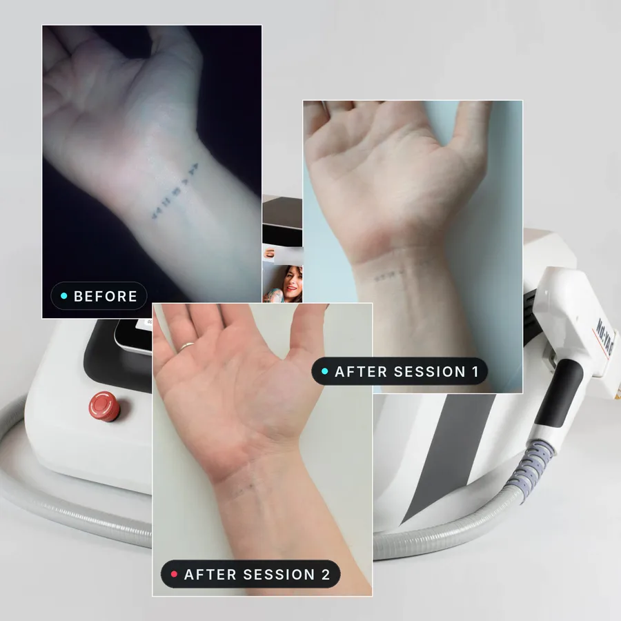 Three photos of a fine-line wrist tattoo: before treatment, after session 1 much lighter, after session 2 only a few faint dots
